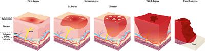 The role and therapeutic potential of gut microbiome in severe burn